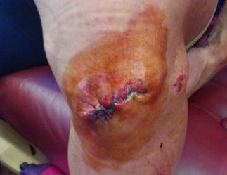Afschuwelijk: knie in stukken, maar toch doorfietsen