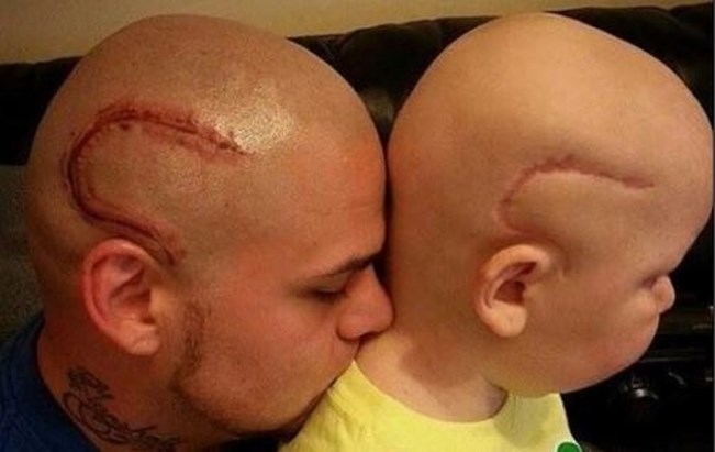 Uitgelezene Vader vereeuwigt litteken zoon in tattoo om hem zelfvertrouw GZ-19