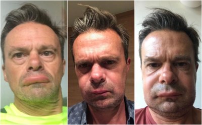 Lieven Van Gils Bijna Onherkenbaar Na Wespensteek Gazet Van